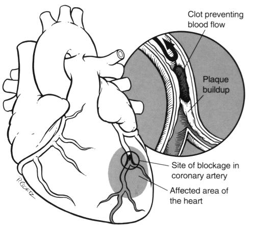 If myocardial ischemia is accompanied by chest pain or discomfort, it is called angina pectoris.