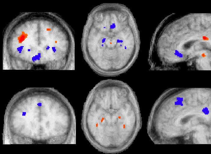 Neuroimaging: A Predictive Biomarker?