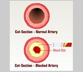 Atherosclerosis of the coronary arteries is the most common cause of heart attack. (Refer fig. 7 & 8) Unit 2: Heart Failure Heart Attack (Fig. 7) (Fig.