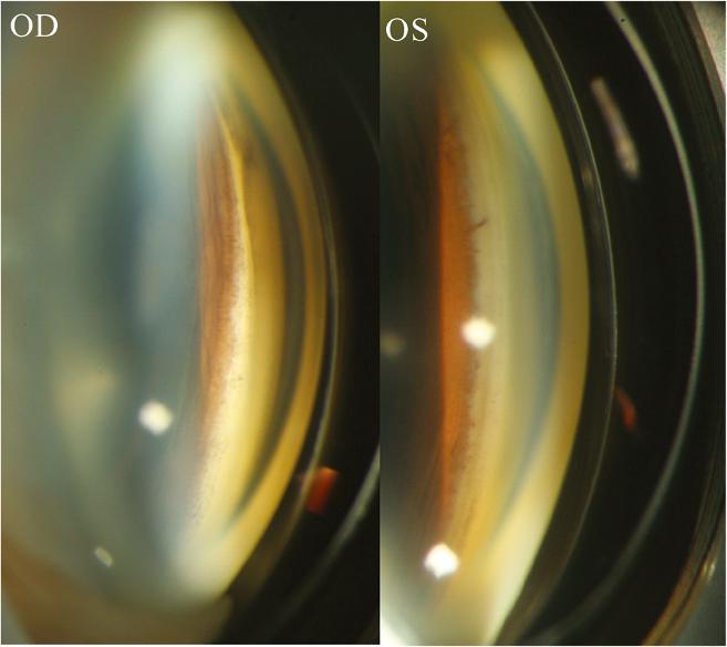 Chang et al. BMC Ophthalmology 2013, 13:22 Figure 1 Pigmentation of the angle structure after the implantation of a foldable intraocular lens (IOL) in the ciliary sulcus of one patient.