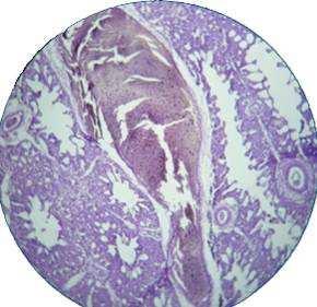 Fig. (5) Histopathological section of myocardium of edema and infiltration of