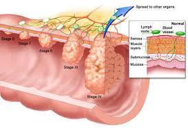 Probiotics - Colon cancer Colorectal cancer is the third most common in cancers.