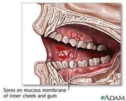 Probiotics Oral Cancer Probiotics are now being regarded as an option for cancer prevention.