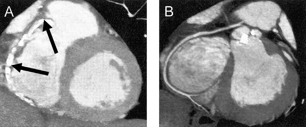2022 Gilard et al. JACC Vol. 47, No. 10, 2006 MSCT and Aortic Valve Stenosis May 16, 2006:2020 4 Figure 2. (A) Calcified, nonassessable right coronary artery. Black arrows heavily calcified areas.