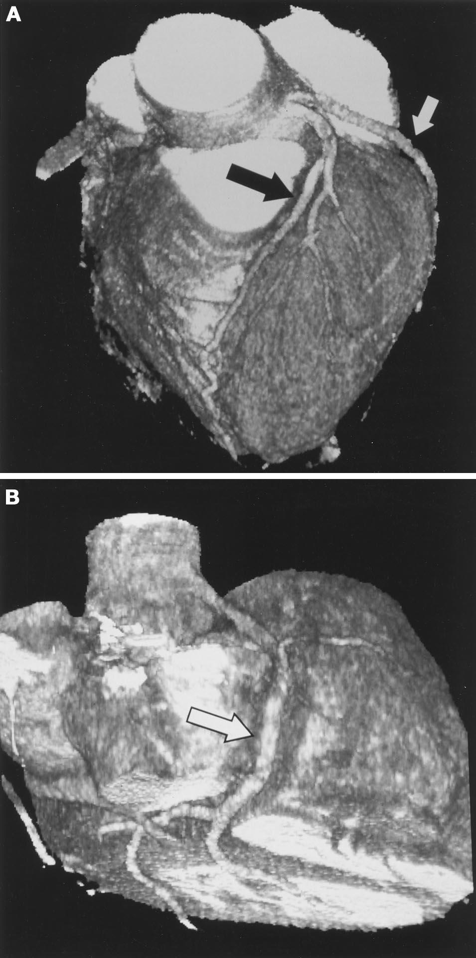 Achenbach et al Coronary Angiography by Multislice Spiral CT 2825 Figure 4.