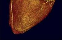 suspected acute coronary syndrome. Multislice computed tomography showed no coronary artery calcium (A).