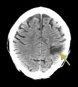 What is stroke? Stroke is a type of brain injury.