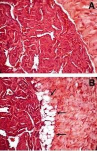 These tissue architecture changes result in a decrease of cavernosal compliance