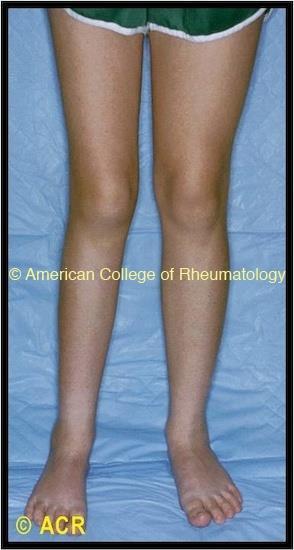 Complications Flexion Contracture Leg Length Discrepancy