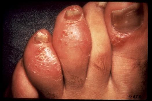 Psoriatic Arthritis Often precedes the onset of psoriasis in children Clues to diagnosis: 1 st degree relative with psoriasis Nail pitting DIP
