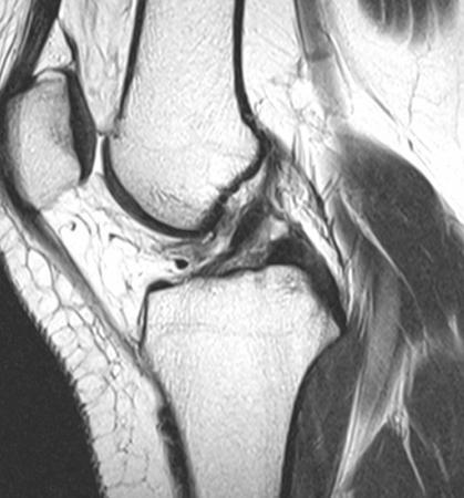 T2W sagittal image, complete ACL tear with non- visualization of fibers.