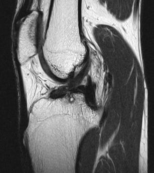 cruciate ligament with ligament laxity. The tear was confirmed by arthroscopy.