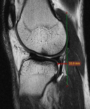 condyle, which is indirect sign of ACL tear.