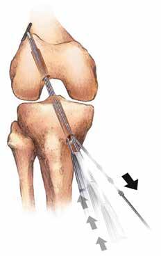 Figure 11 Figure 12 Figure 10 Figure 13 Figure 14 Position Graft in Femoral Tunnel Ensure the zip suture is anterior to the graft