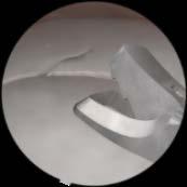Surgical cases Meniscectomy I Lateral meniscus radial tear Remove damaged parts