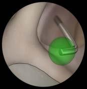 right shoulder joint Switch the scope from the posterior to the anterior portal to