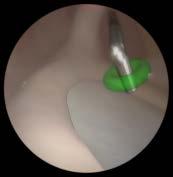 the subacromial space Touch all the spheres with the hook for two seconds