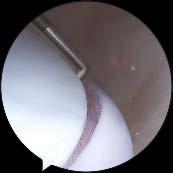 Diagnostic VI Bankart lesion; detachment of the anterior