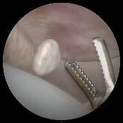 Surgical cases Loose body removal Locate the loose bodies in the hip joint Carefully select the appropriate portals for