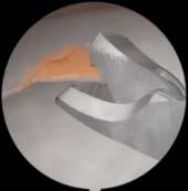 Meniscectomy I Guided resection of a meniscus tear with