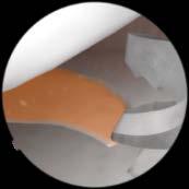 Meniscectomy II Guided resection of a parrot beak meniscus