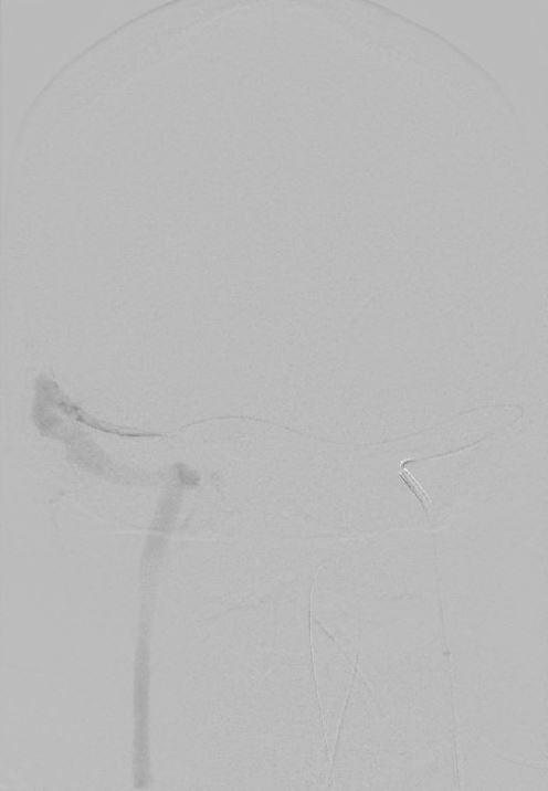 Transvenous thrombolytic administration 6 Fr Envoy guiding catheter in the left internal jugular vein over a 0.035- inch steerable and Prowler PLUS 0.