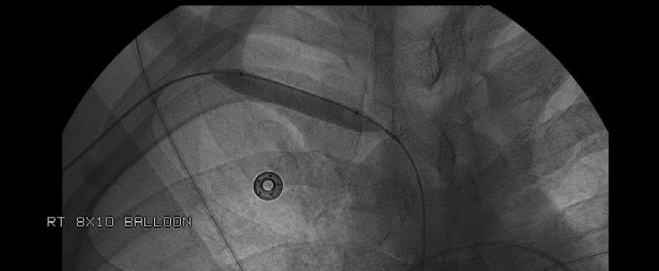 syndrome A) Possis angiojet pure thrombectomy device cleared clot from subclavian vein B)