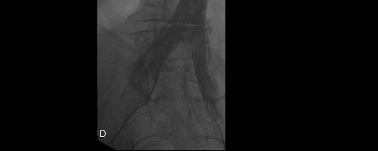 thrombus B) and C) Kissing EKOS catheters placed simultaneously with TNK