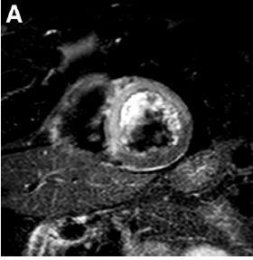 Method to evaluate myocardial salvage T2W and DE CMR imaging T2W CMR :