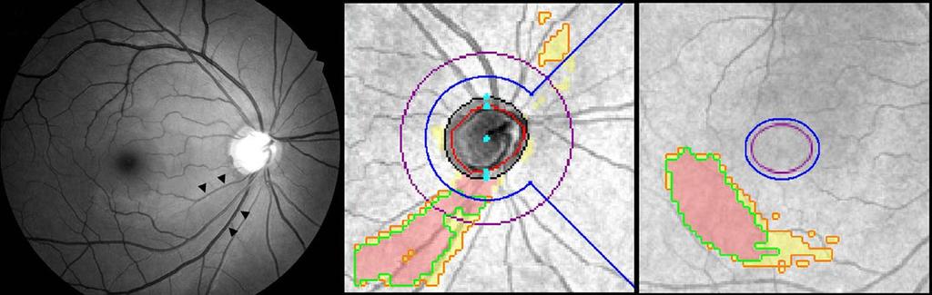 (A) (B) (C) Fig. 1. Calculation of aberrant deviation-map superpixels corresponding to localized retinal nerve fibre layer (RNFL) defect using customized Matlab program.