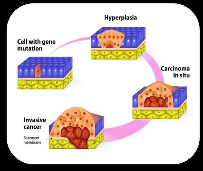 What is Cancer? A REVOLT OF CELLS Cancer is the uncontrolled growth and spread of cells. The growth often invade surrounding tissue and can metastasize to distant sites.