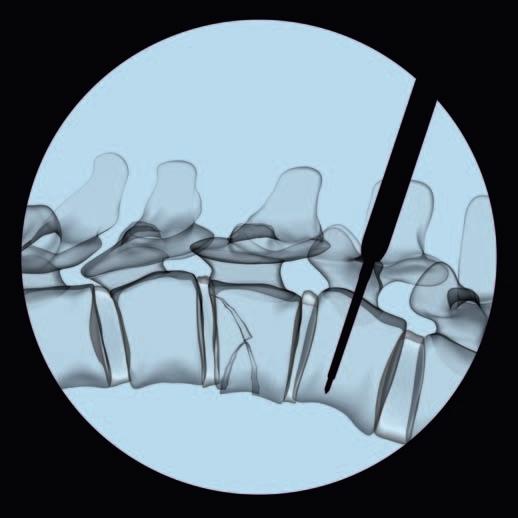 Precaution: Use radiographic imaging to confirm orientation and depth while inserting the pedicle awl.