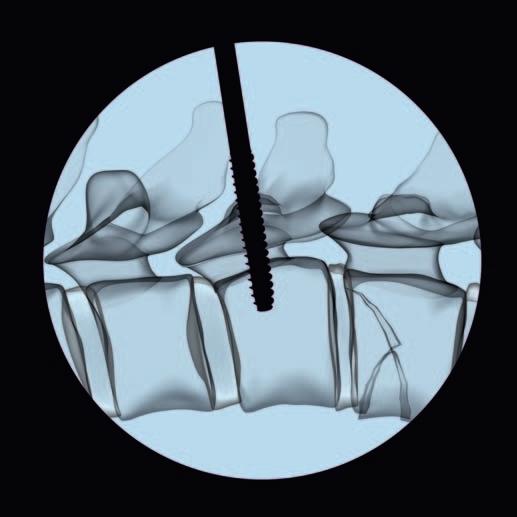 Screw Insertion Notes on the optional use of perforated Schanz screws: If perforated Schanz screws are used, assess the cortical shell for perforations.
