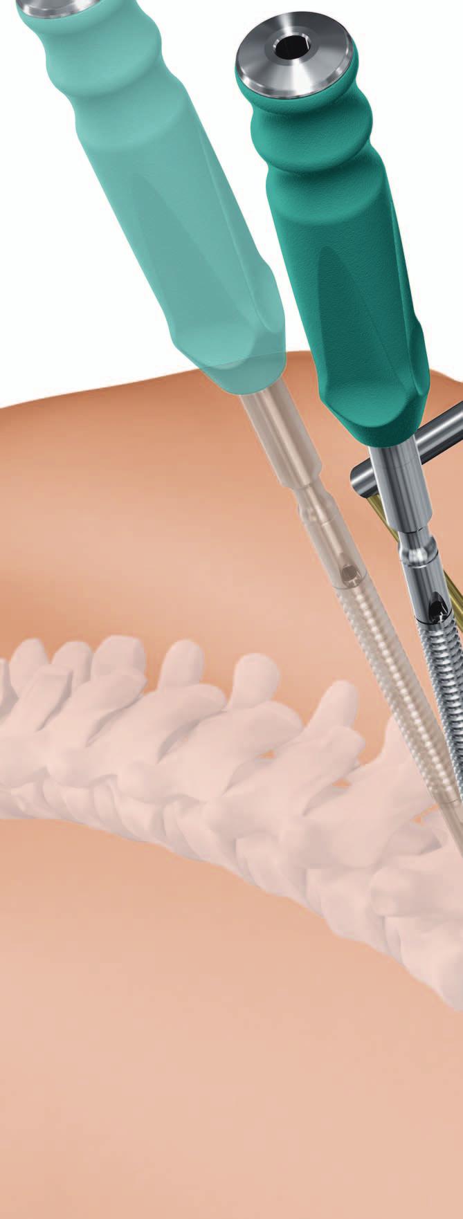 USS Fracture MIS. The minimally invasive Schanz Screw system for complete spinal fracture reduction.