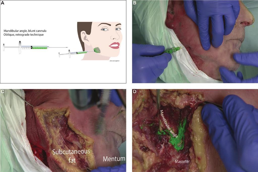van Loghem et al 11 Figure 9. Mandibular angle injected with blunt cannula demonstrated on a 93-year-old female cadaver. (A) Schematic diagram of supraperiosteal injection technique.