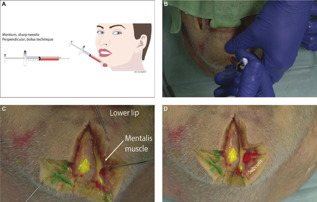 van Loghem et al 13 Figure 11. Mentum injected with sharp needle demonstrated on an 85-year-old male cadaver. (A) Schematic diagram of supraperiosteal injection technique.