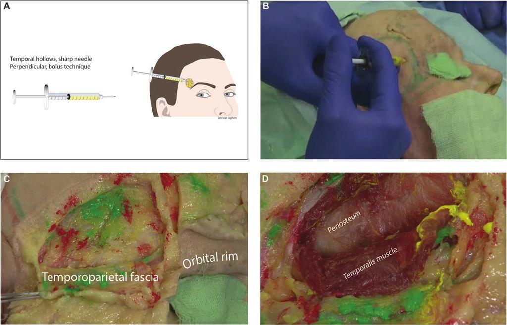 van Loghem et al 5 Figure 3. Temporal hollow injected with sharp needle demonstrated on an 85-year-old male cadaver. (A) Schematic diagram of supraperiosteal injection technique.