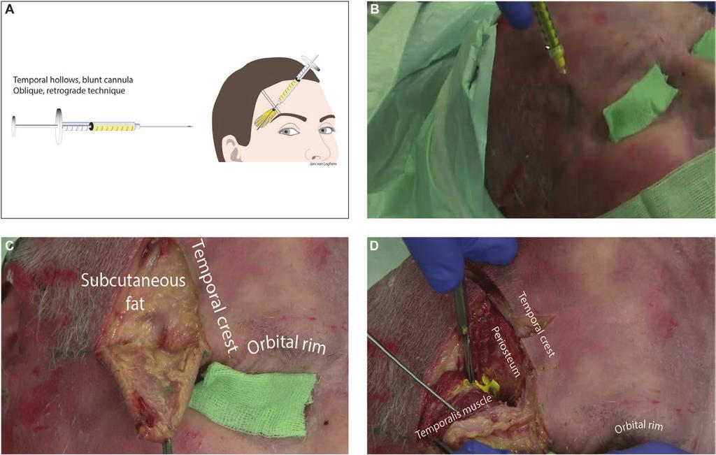 6 Aesthetic Surgery Journal Figure 4. Temporal hollow injected with blunt cannula demonstrated on a 93-year-old female cadaver. (A) Schematic diagram of supraperiosteal injection technique.
