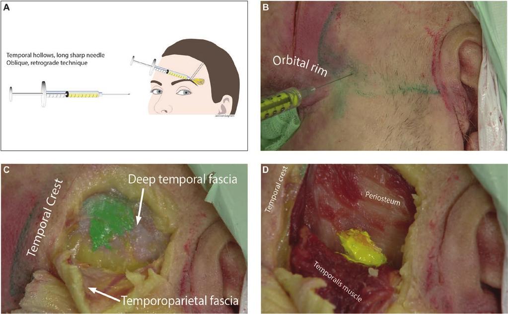 van Loghem et al 7 Figure 5. Temporal hollow injected with long sharp needle demonstrated on an 85-year-old male cadaver. (A) Schematic diagram of supraperiosteal injection technique.