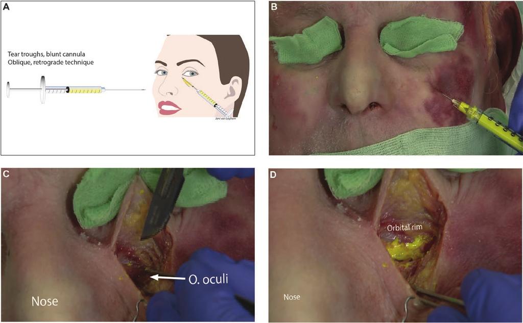 van Loghem et al 9 Figure 7. Tear trough injected with blunt cannula demonstrated on a 93-year-old female cadaver. (A) Schematic diagram of supraperiosteal injection technique.