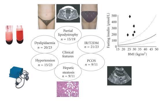 Clinical features exhibited by adult subjects harboring loss-of-function mutations in PPARγ (numerator denotes the reported number