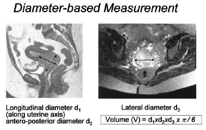 Diameter-based ellipsoidal method Clinical tumor size MRI tumor size MRI
