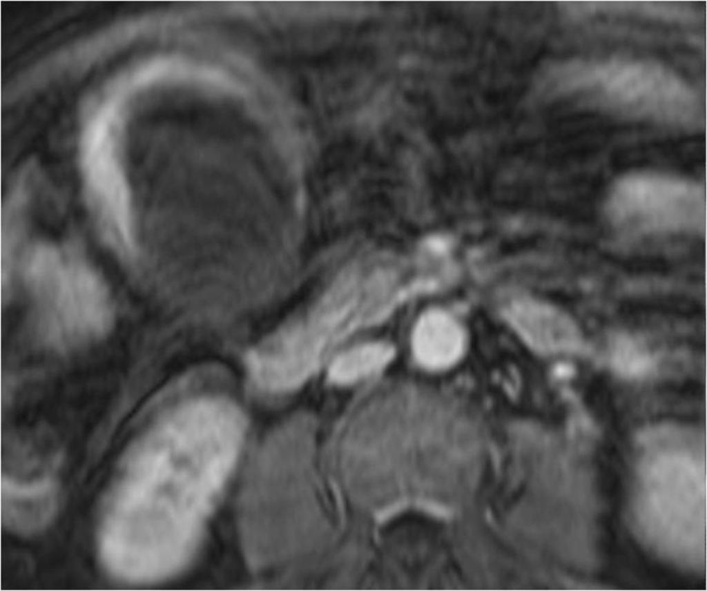 Fig. 10: Axial post-gadolinium MRI, whilst significantly degraded by respiratory motion artefact,