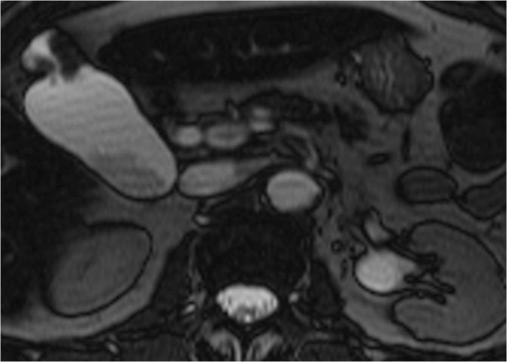 Fig. 12: Axial T2 true FISP MRI reaffirms nodular segmental gall bladder