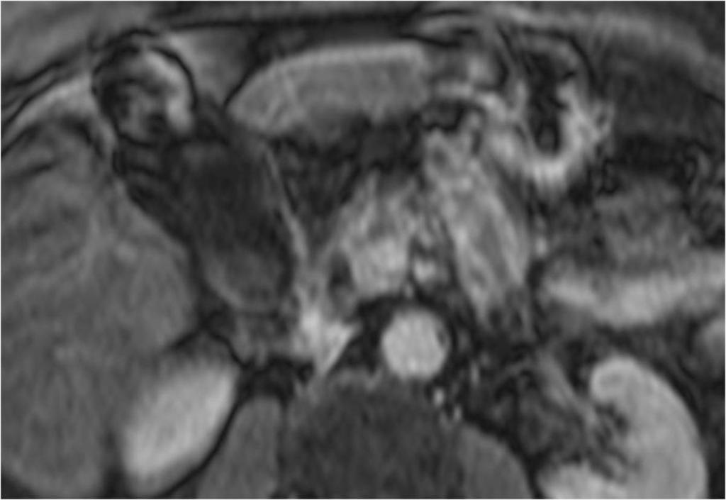 13: Axial post-gadolinium T1-weighted fat sat MRI, degraded by motion