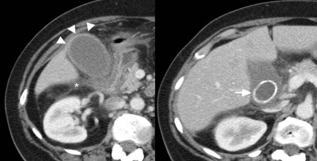 Fig. 3: Axial contrast enhanced CT demonstrating mural thickening with