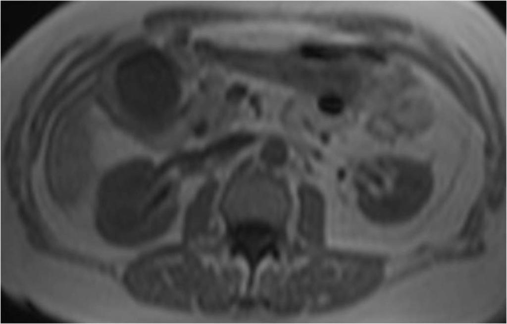 Fig. 6: Axial pre contrast T1-weighted MRI demonstrates hypointense gallbladder