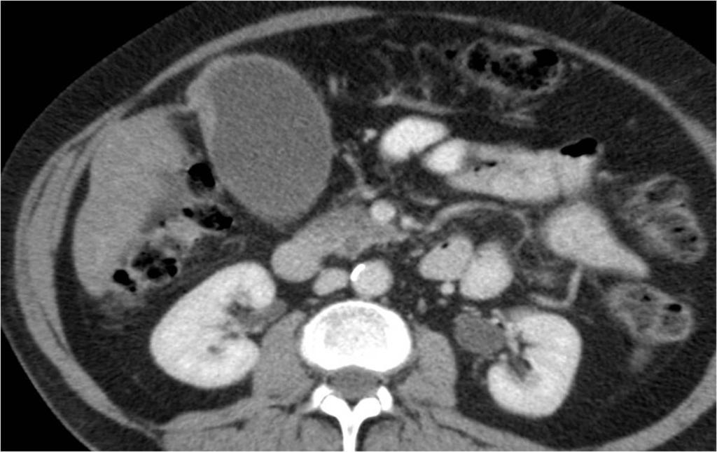 Fig. 8: Axial post contrast CT demonstrating focal