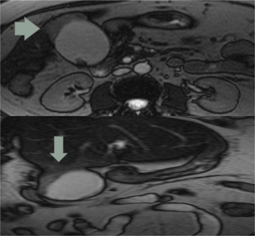 Fig. 9: Axial (top) and Coronal (bottom) True FISP MRI demonstrates a focal segment of gall bladder wall thickening obliterating