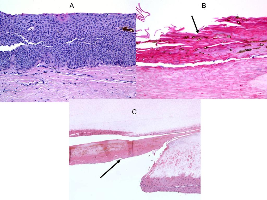 Pigmented lesions of the nail unit Table 2 Causes of Nail Pigmentation Melanocytic activation/hypermelanosis Trauma Medications Racial pigmentation Endocrinopathy Pregnancy Peutz-Jeghers and